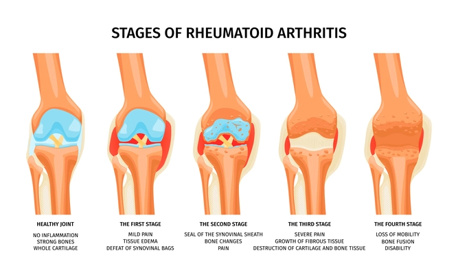 Realistic infographics showing four stages of rheumatoid arthritis of knee joint vector illustration