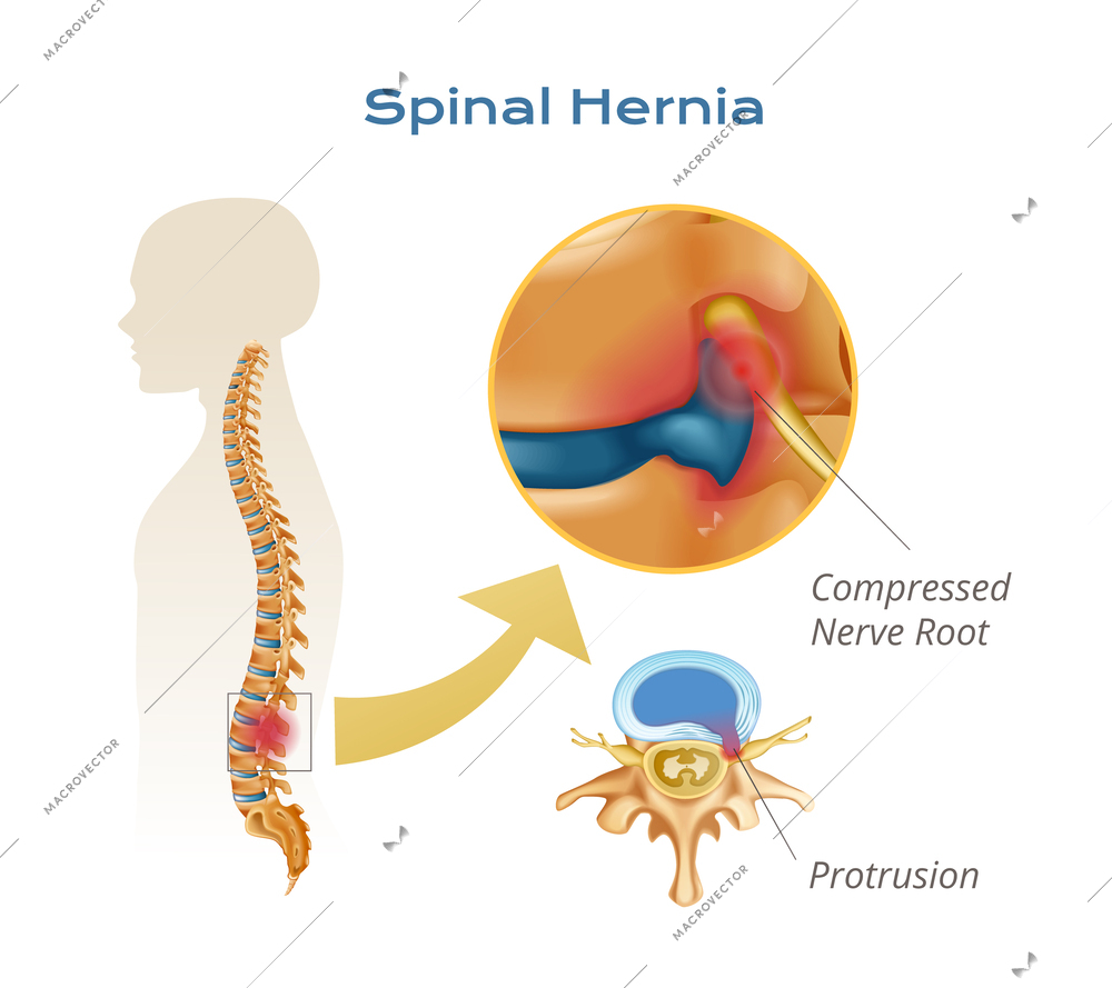 Vertebrae spinal cord anatomy infographics with body silhouette with spine and compressed nerve root protrusion views vector illustration