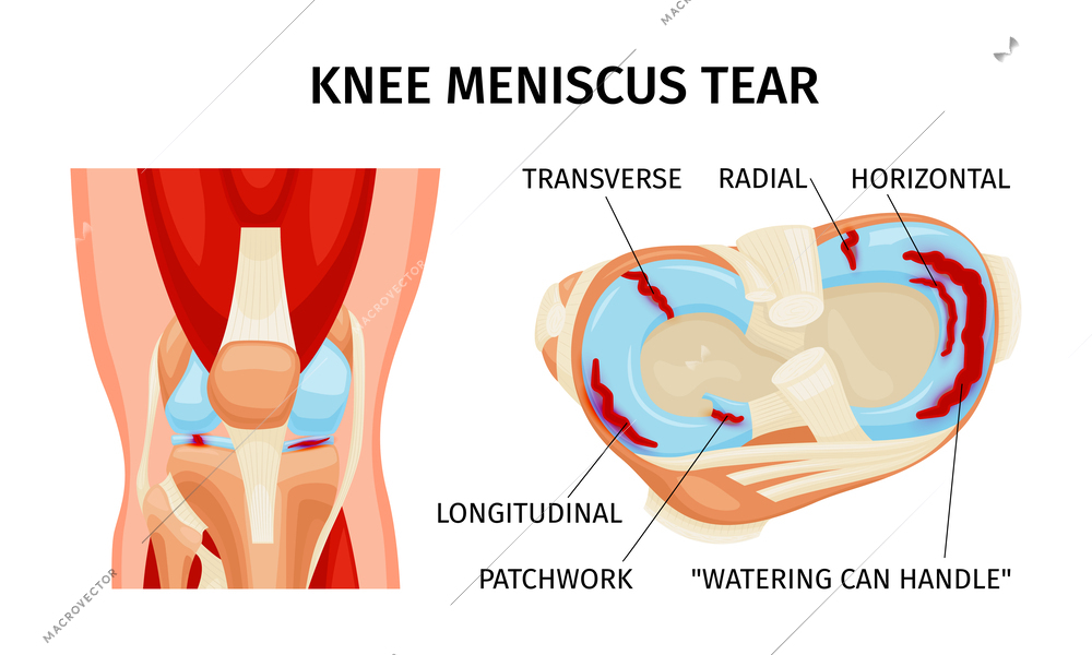 Knee meniscus tear anatomy diagram realistic infographics on white background vector illustration