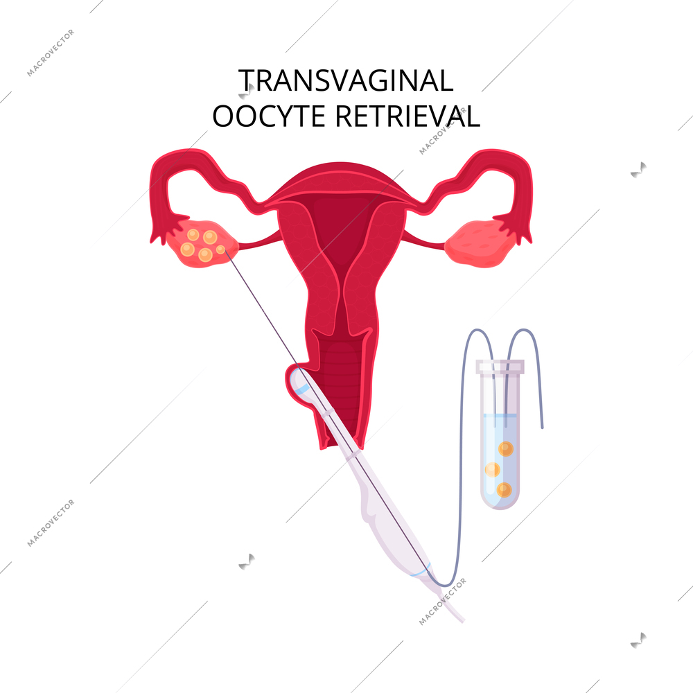 In vitro fertilization ivf flat composition with text captions and artificial insemination icons vector illustration