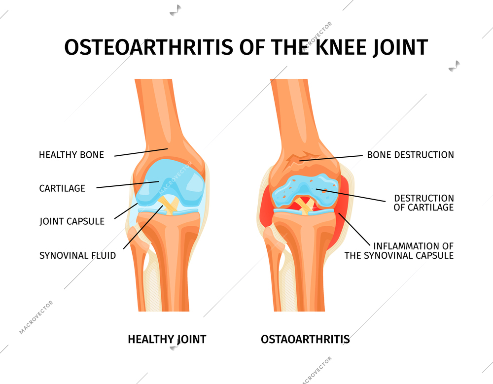 Realistic infographics with anatomy of healthy knee and osteoarthritis of joint with labelled parts vector illustration