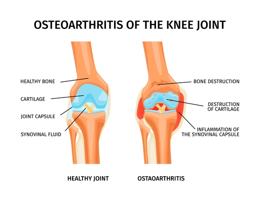 Realistic infographics with anatomy of healthy knee and osteoarthritis of joint with labelled parts vector illustration