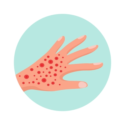 Allergy symptom flat icon with hand covered with allergic red rashes vector illustration