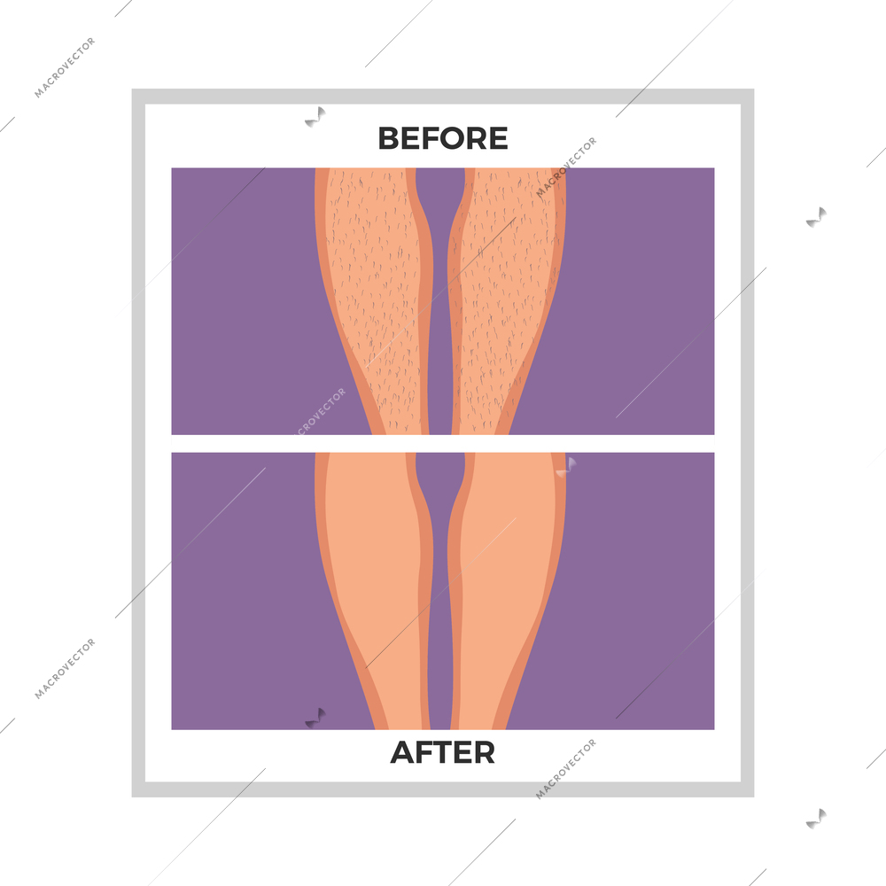 Hair removal legs before and after depilation flat vector illustration
