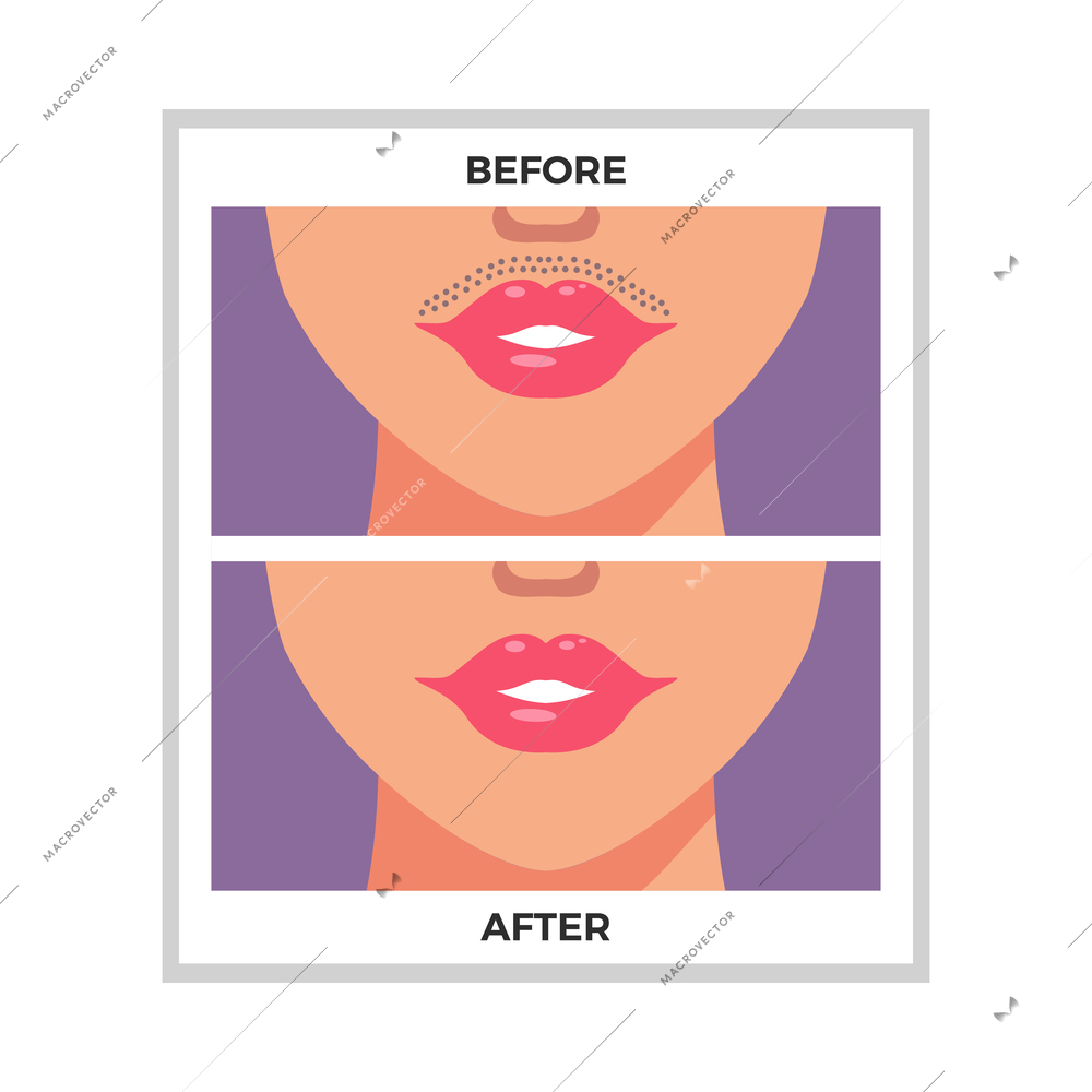 Lips area before and after hair removal flat vector illustration