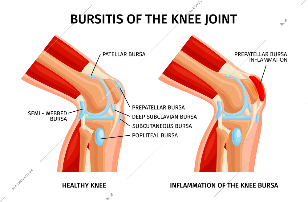 Bursitis of knee bursa realistic infographics with anatomy of healthy and unhealthy joints vector illustration