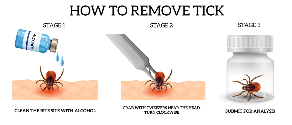 Realistic spider mite remove infographics with three stages of how to remove tick vector illustration