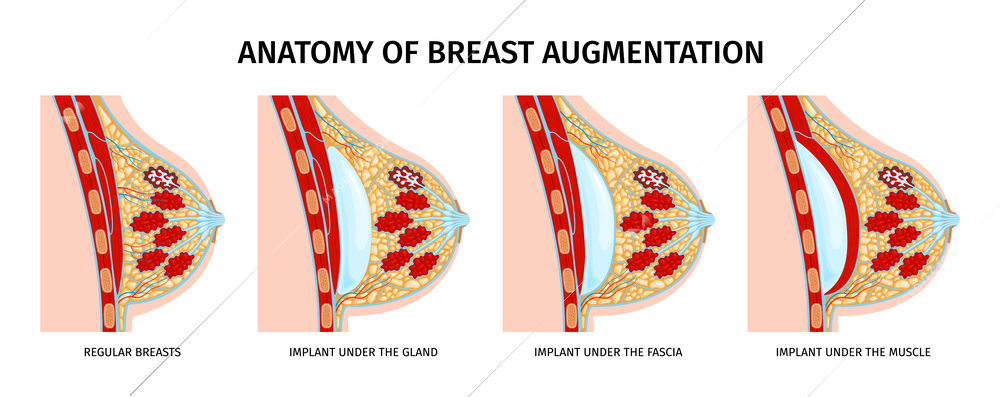 Female breast anatomy implants set of isolated compositions with profile views of breasts and text captions vector illustration