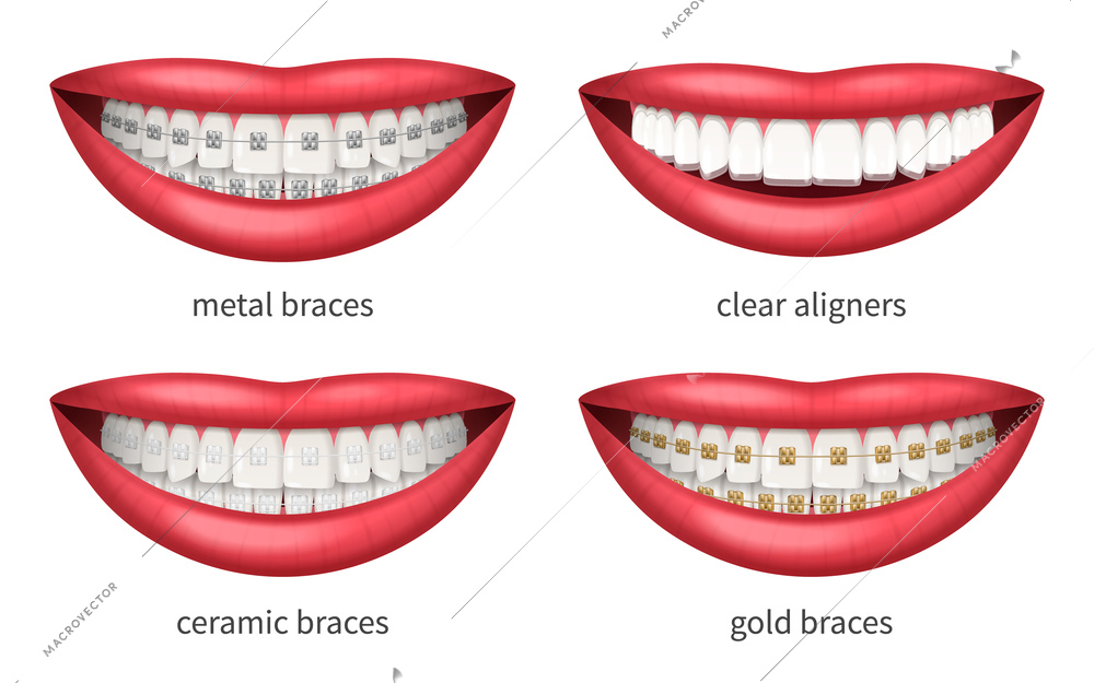 Teeth dental braces icons set with realistic human lips isolated vector illustration