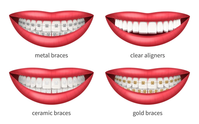 Teeth dental braces icons set with realistic human lips isolated vector illustration