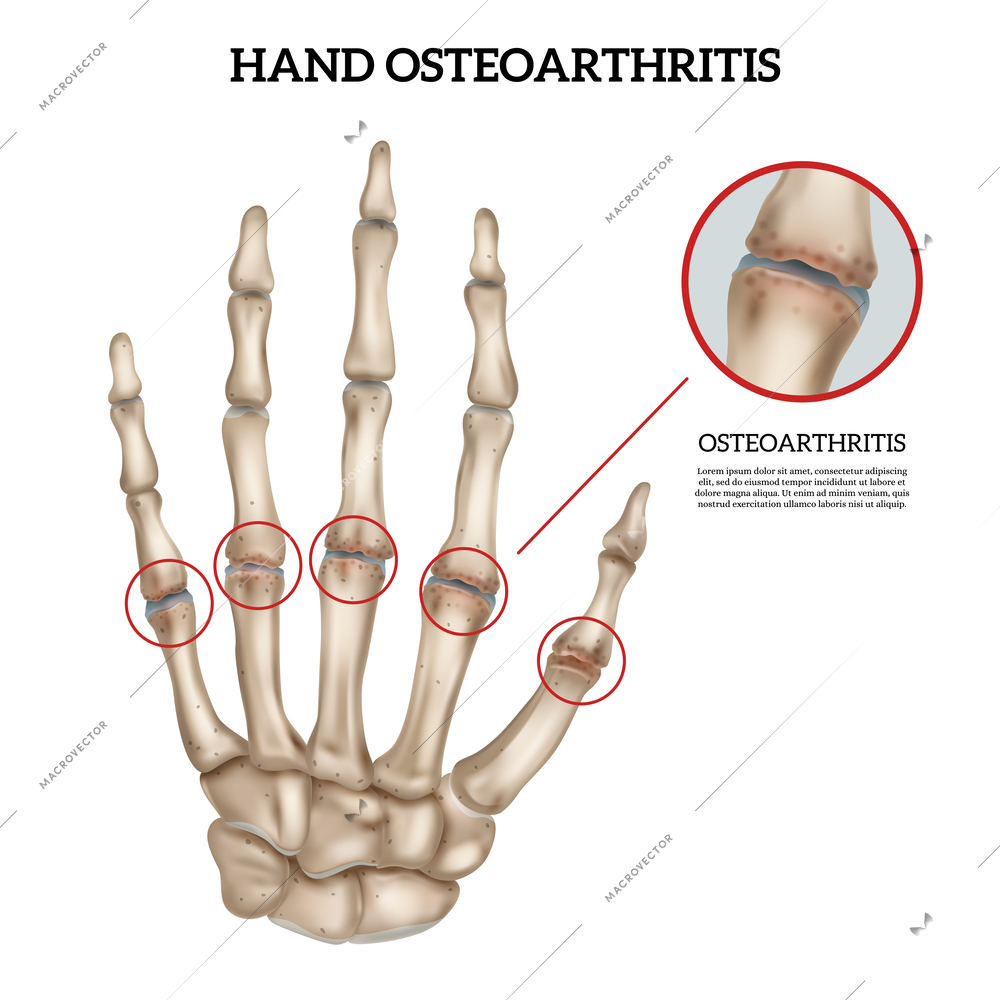 Realistic hand osteoarthritis anatomy infographic on white background vector illustration