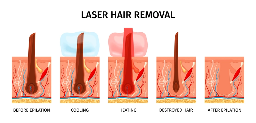 Realistic laser hair removal composition with isolated profile views of scalp during laser removal epilation procedure vector illustration