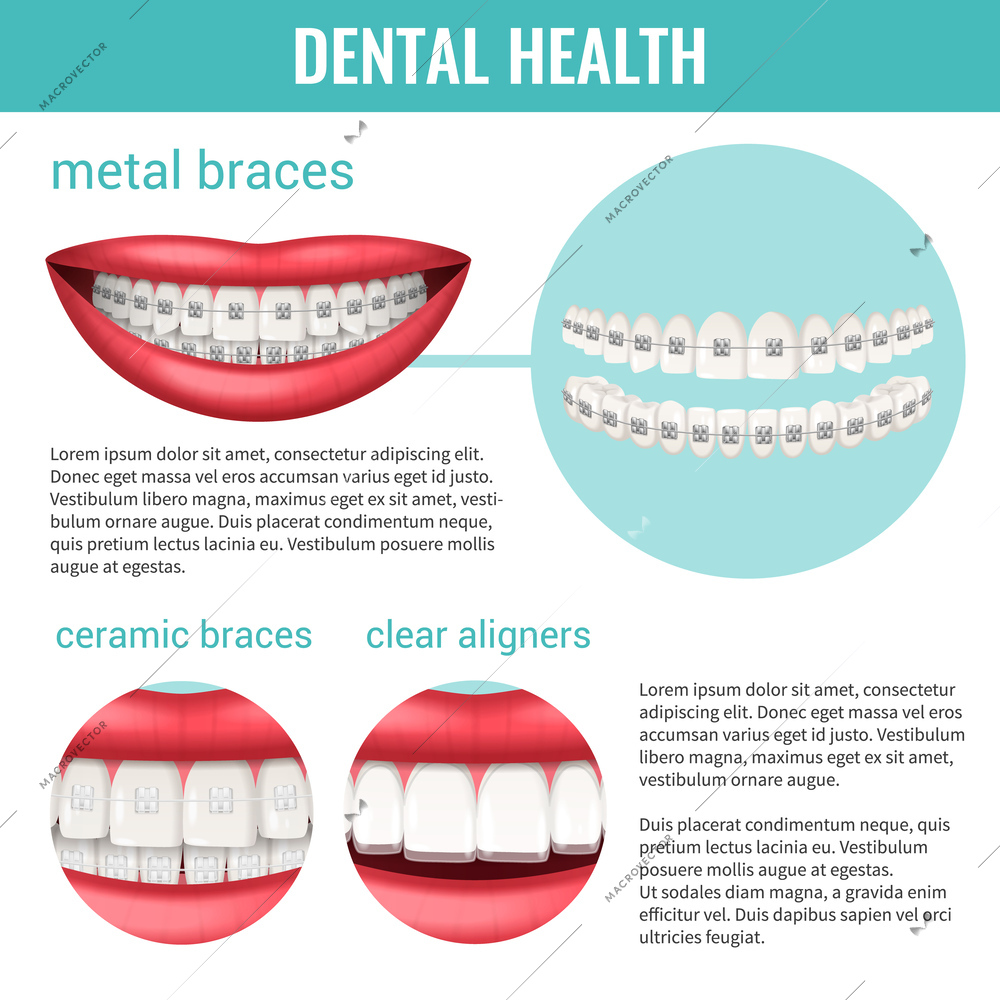 Dental health infographics set with metal and ceramic braces realistic vector illustration