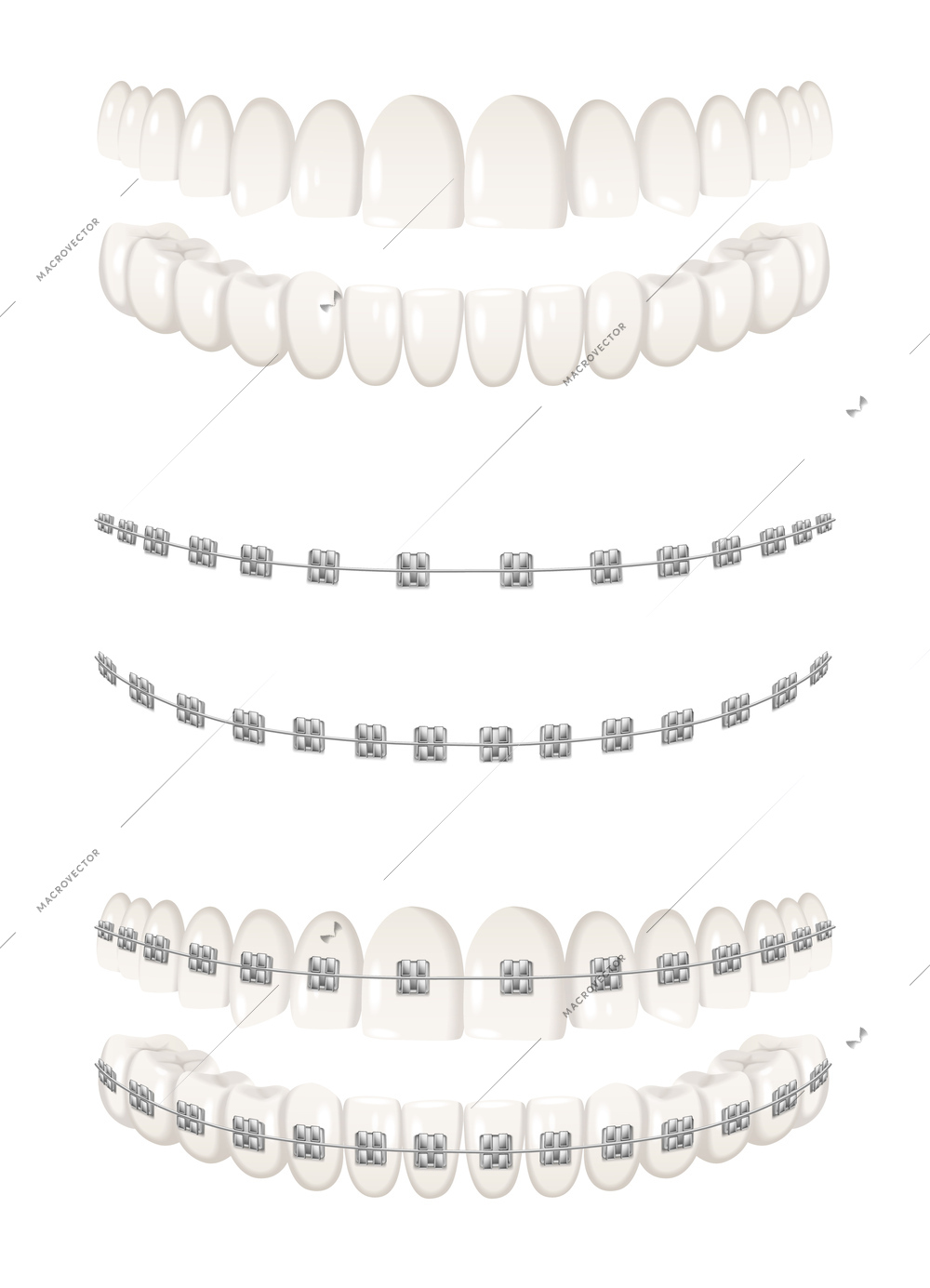 Teeth dental braces realistic icons set isolated vector illustration