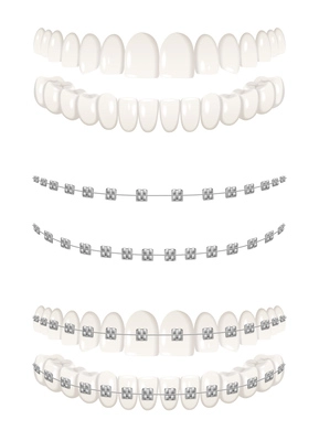 Teeth dental braces realistic icons set isolated vector illustration