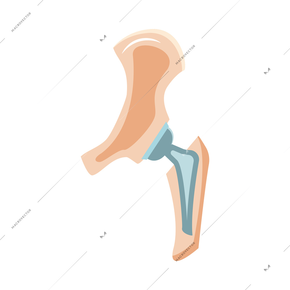 Artificial joint prosthesis flat icon vector illustration