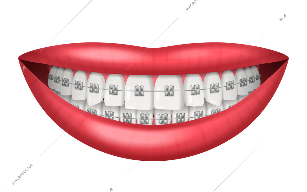 Teeth dental braces realistic isolated on white background vector illustration