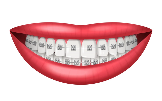 Teeth dental braces realistic isolated on white background vector illustration