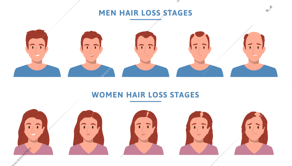 Hair loss alopecia people flat icon set the five stages of alopecia step by step vector illustration