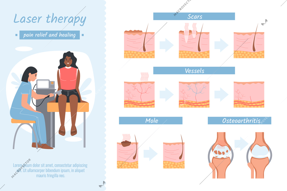 Laser therapy flat infographics with medical diagram views of skin structure hair removal and human characters vector illustration