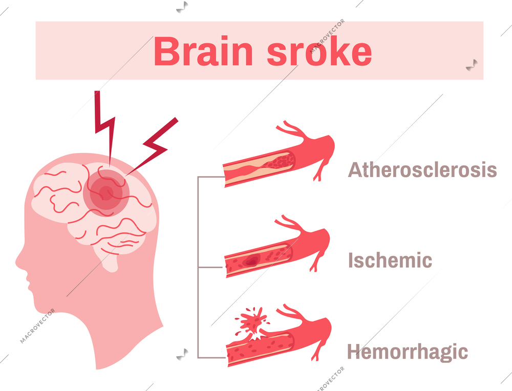 Types of brain stroke flat infographics on white background vector illustration