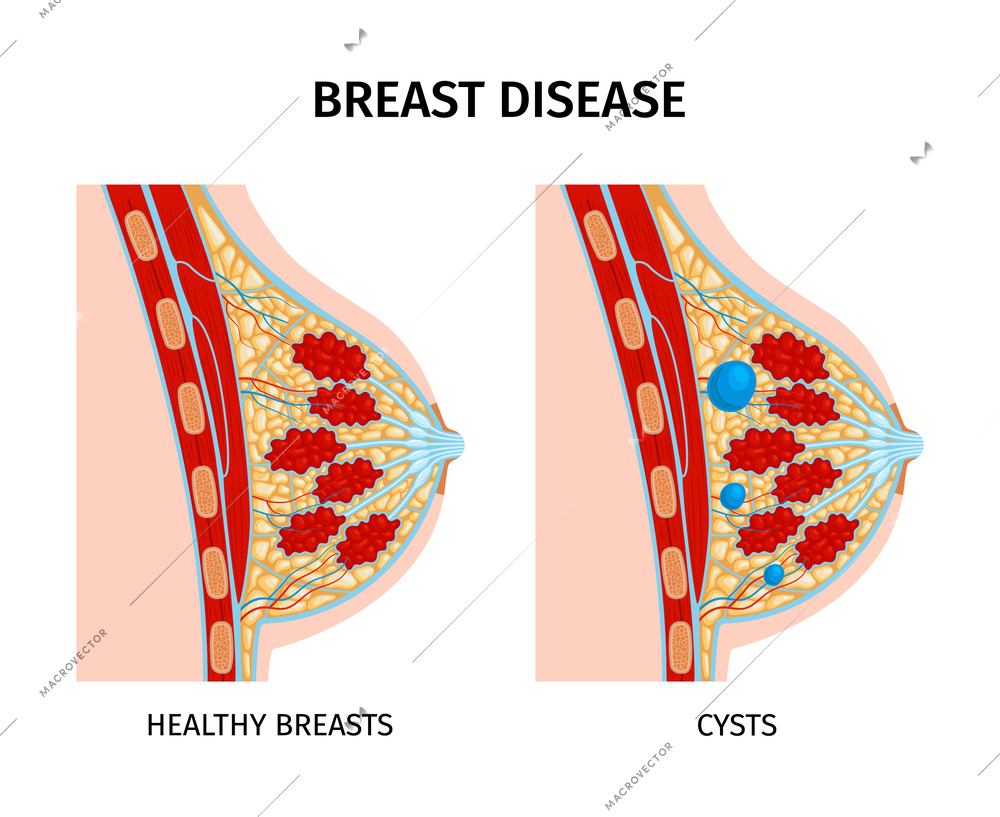 Female breast anatomy cyst composition with two isolated views of healthy and damaged breasts with text vector illustration