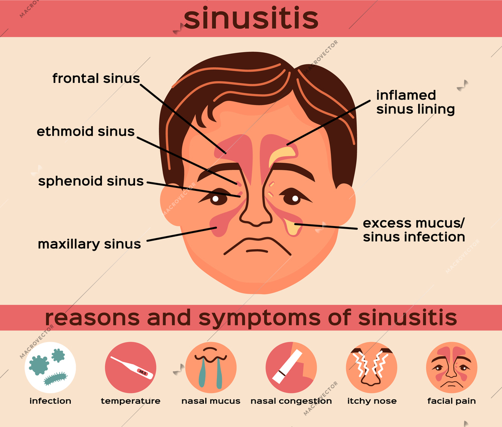 Nasal disease flat infographics layout with reasons and symptoms of sinusitis vector illustration