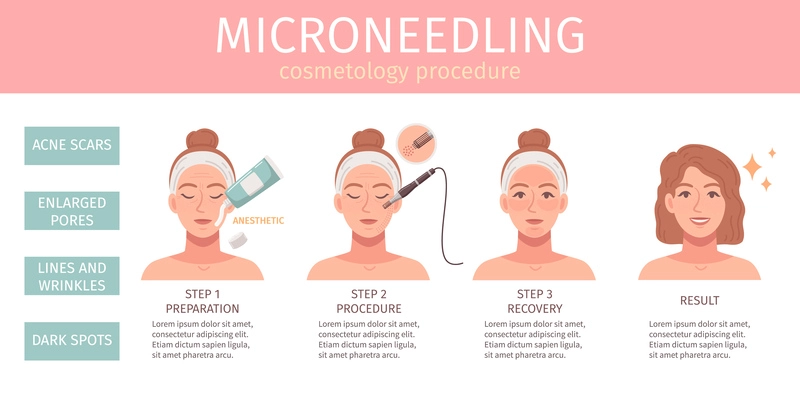 Cosmetology procedures flat cartoon infographics with microneedling treatment procedure vector illustration