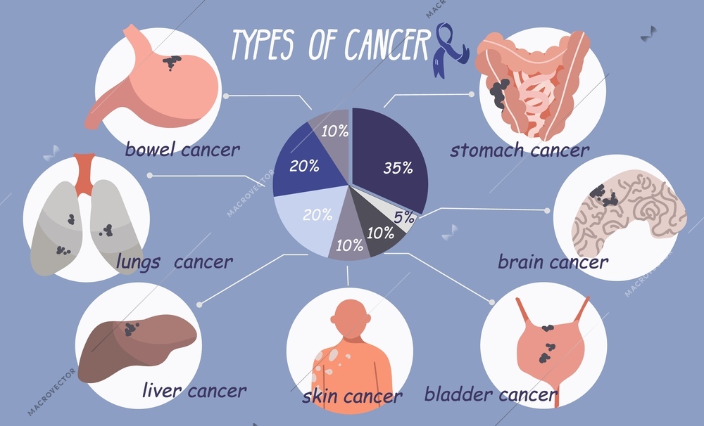 Cancer patient oncology flat infographic composition with radial chart and round compositions representing types of cancer vector illustration