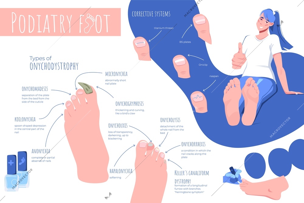 Podiatry foot disease flat infographic composition of human feet images editable text captions and arrow pointers vector illustration
