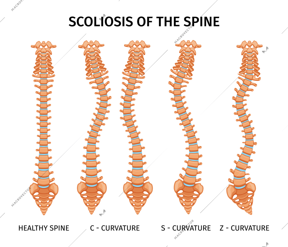 Types of scoliosis of spine infographics with set of isolated spine curvature images on blank background vector illustration