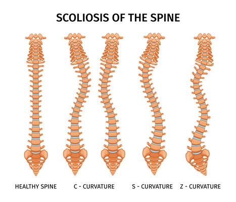 Types of scoliosis of spine infographics with set of isolated spine curvature images on blank background vector illustration