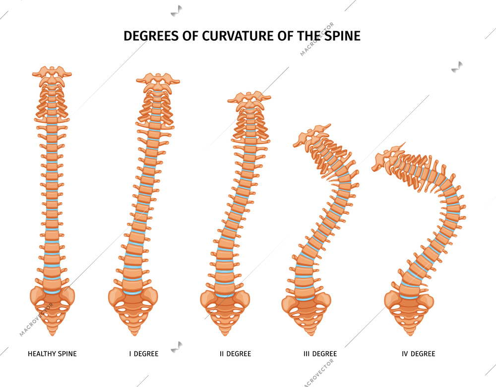 Spine structure anatomy set of isolated icons showing various degrees of spine curvature healthy and ill vector illustration