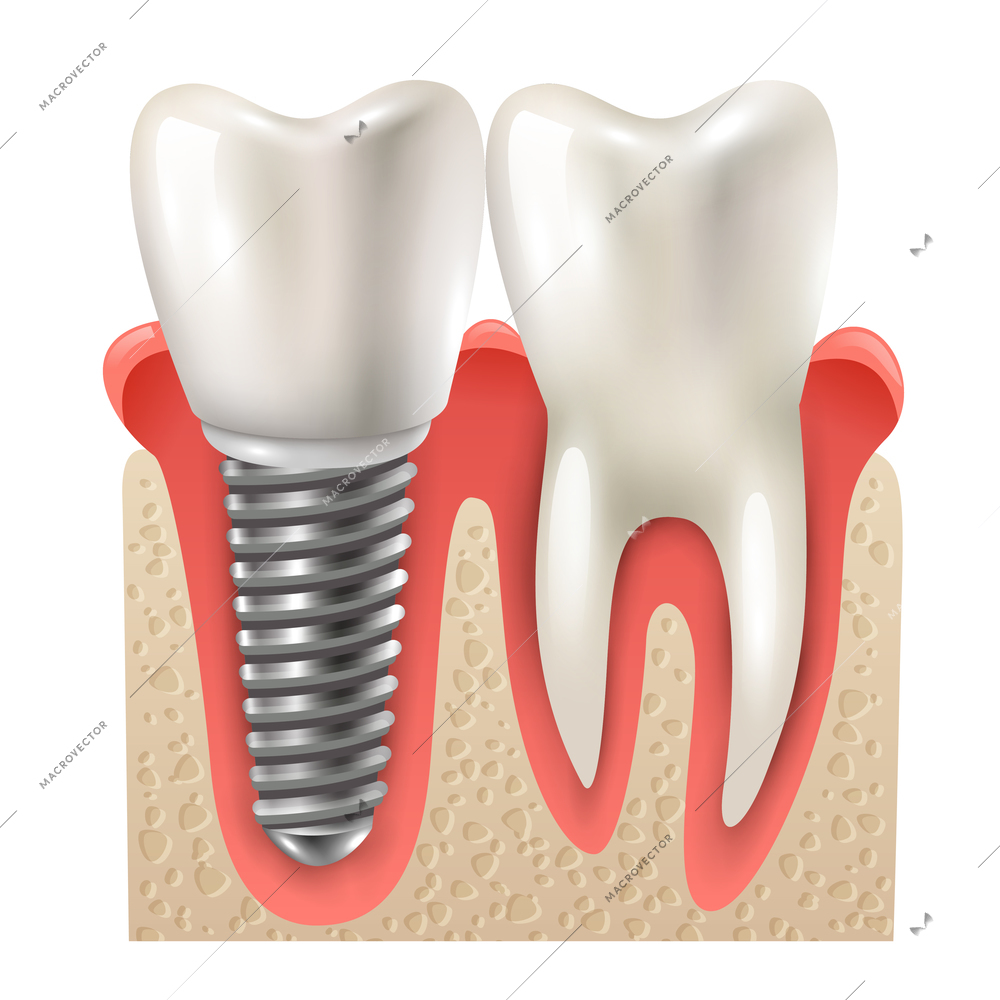 Dental implants and tooth set model closeup side view realistic image vector illustration