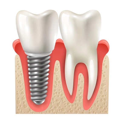 Dental implants and tooth set model closeup side view realistic image vector illustration