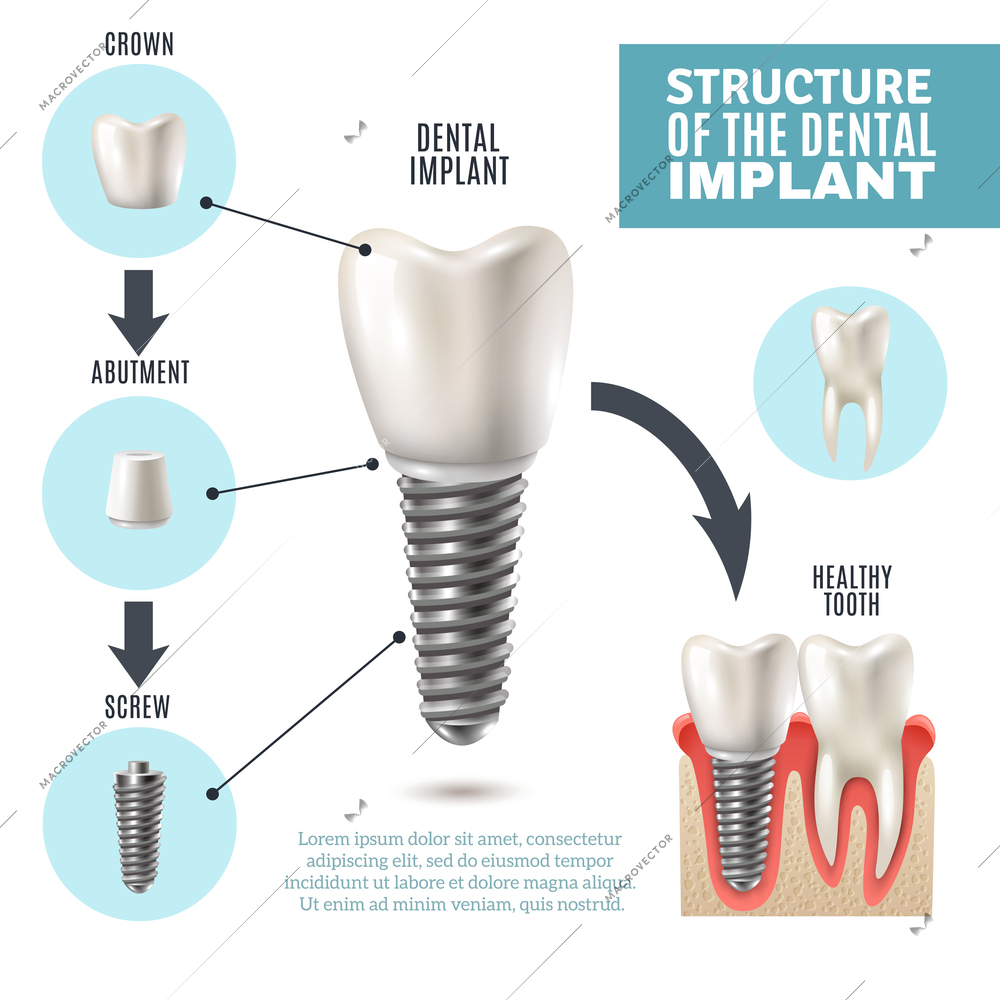 Dental implant structure medical pictorial educative infographic poster with molar replacement end healthy tools models vector illustration