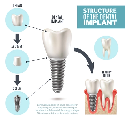 Dental implant structure medical pictorial educative infographic poster with molar replacement end healthy tools models vector illustration