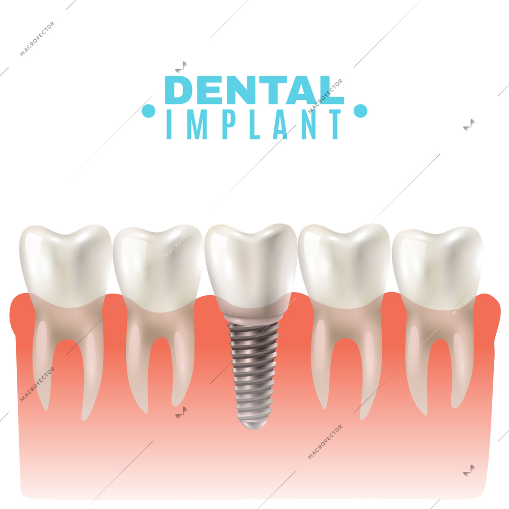 Dental implant model closeup cut away side view educative medical poster vector illustration