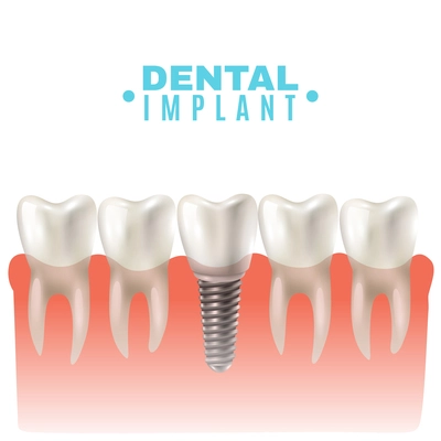 Dental implant model closeup cut away side view educative medical poster vector illustration