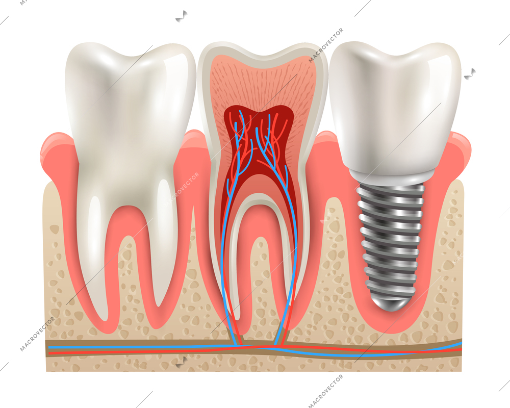 Dental implant and real tooth anatomy closeup cut away section model side view realistic vector illustration