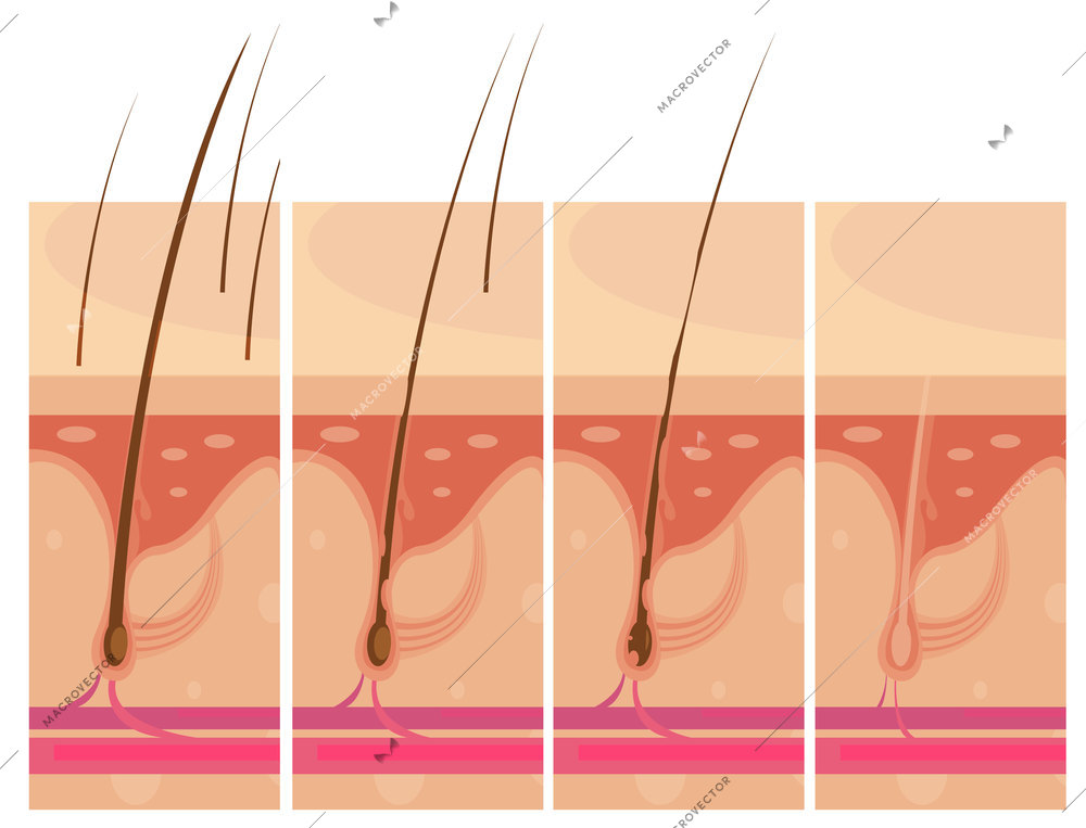 Hair loss storyboard conceptual compositions set with profile macro view of balding scalp skin infographic images vector illustration