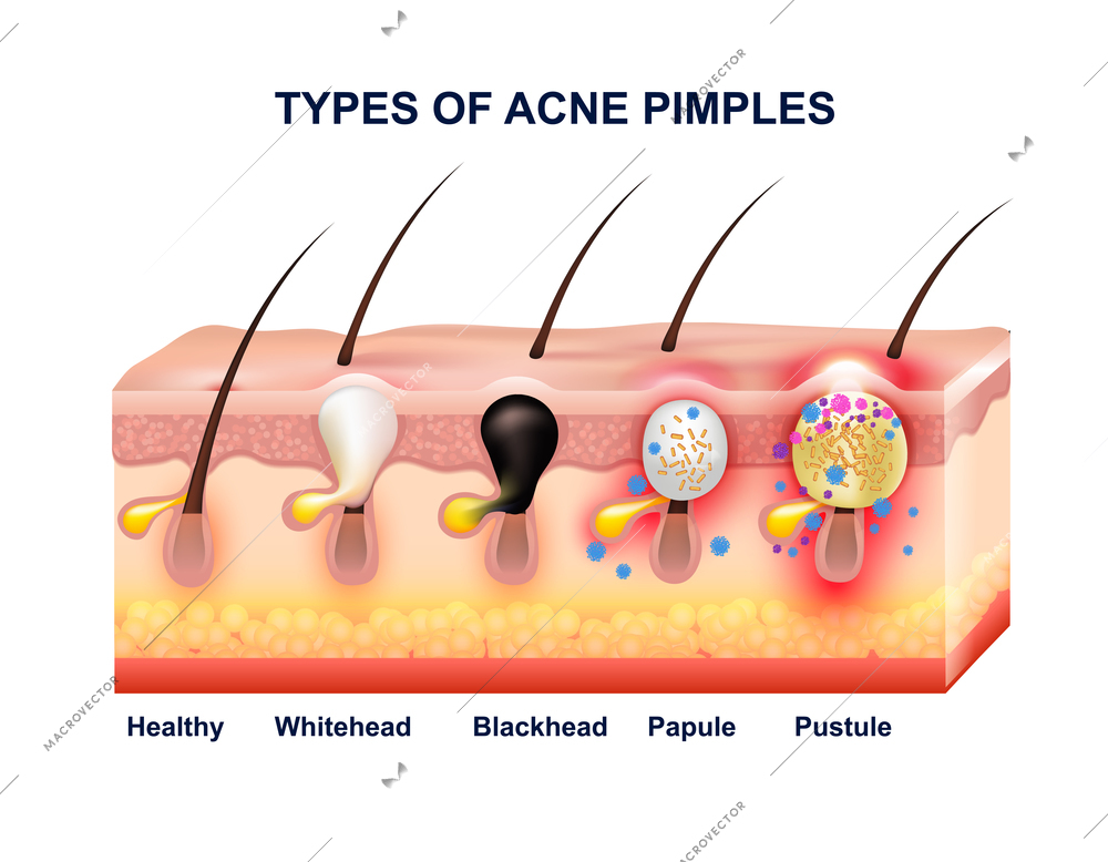 Colored skin acne anatomy composition with types of acne pimples before and after vector illustration