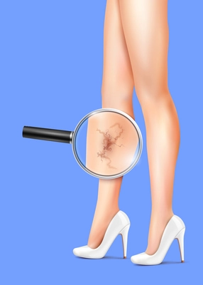 Female slim legs and varicose with health symbols vector realistic illustration