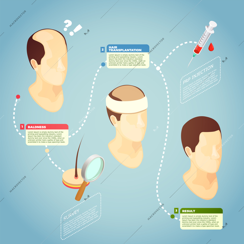 Hair transplantation isometric vector illustration with description surgery procedure of restore hair on bald head