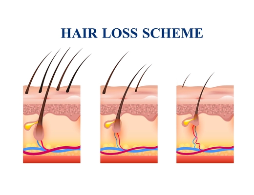 Stages of hair loss on human skin, scheme with anatomy structure including follicles, veins, nerves, vector illustration