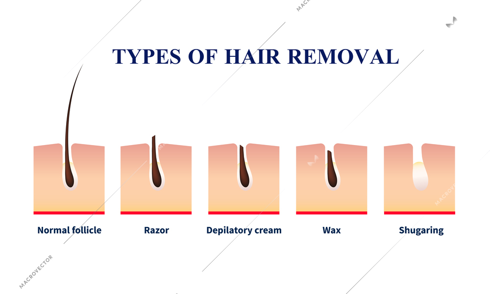 Normal follicle and types of hair removal with help of razor, depilation cream, wax, sugaring vector illustration