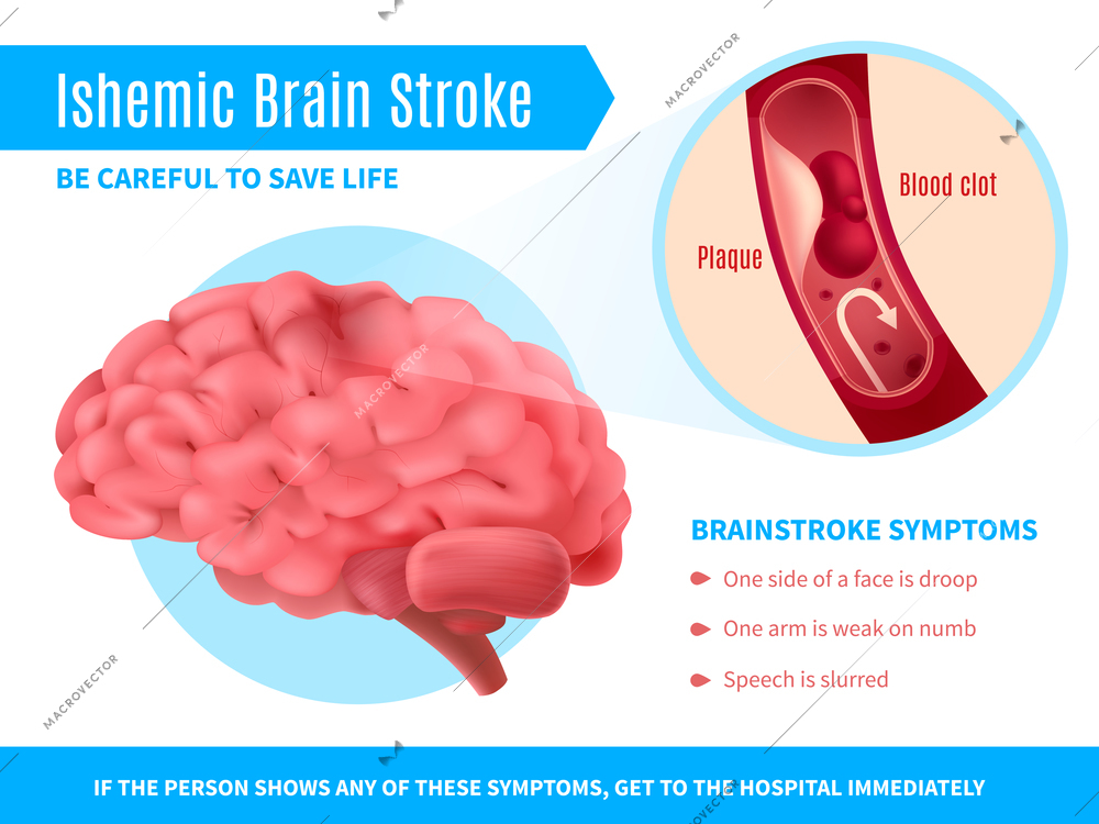 Ischemic brain stroke realistic poster with symptoms list and call to be careful to save life vector illustration