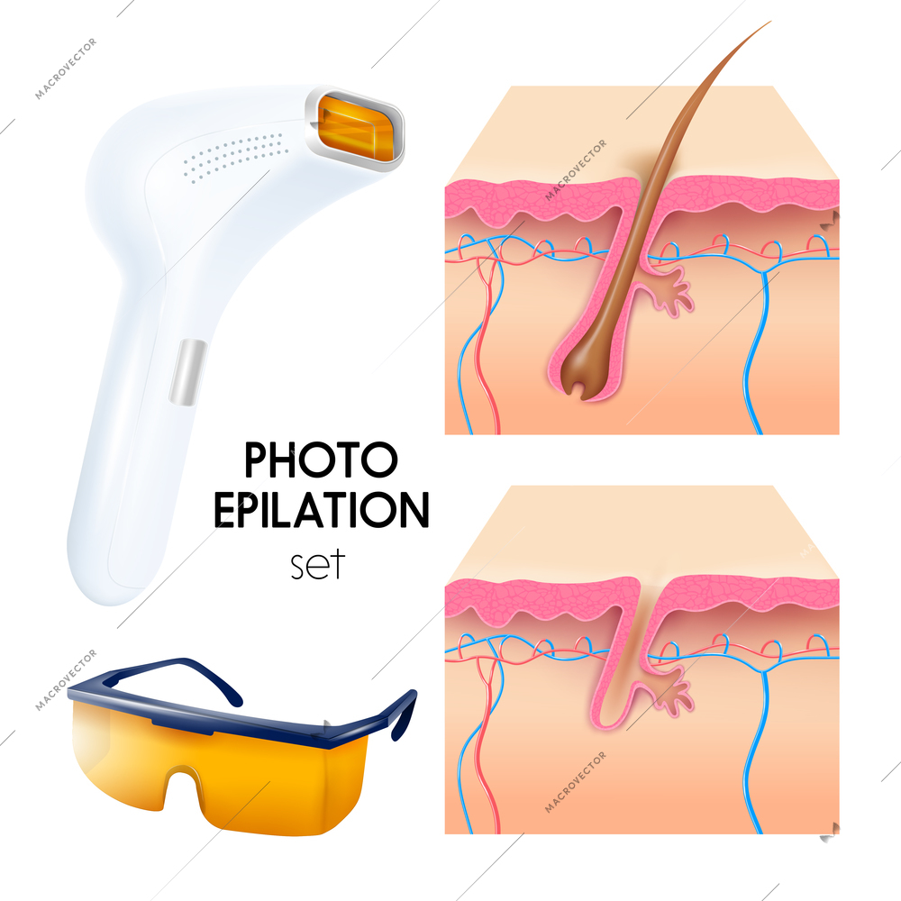 Photo epilation realistic set with epilator protective goggles and cross section of skin layers scheme vector illustration