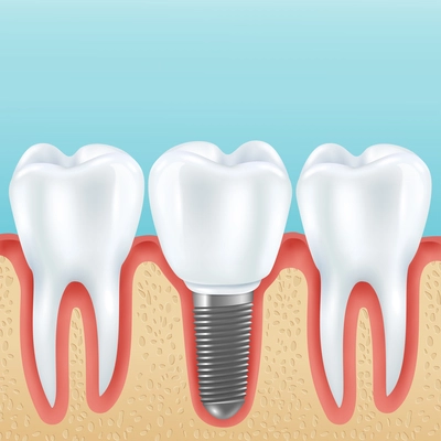 Dental prosthetics realistic vector illustration with healthy teeth and denture crown implanted with implants