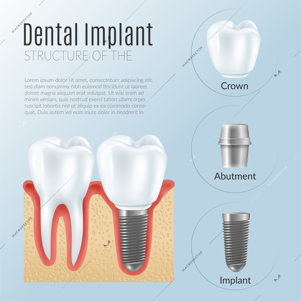 Structure of dental prosthetics infographics poster with denture near healthy tooth crown abutment implant realistic icons vector illustration